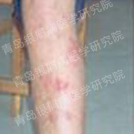 九岁儿童银屑病康复之路